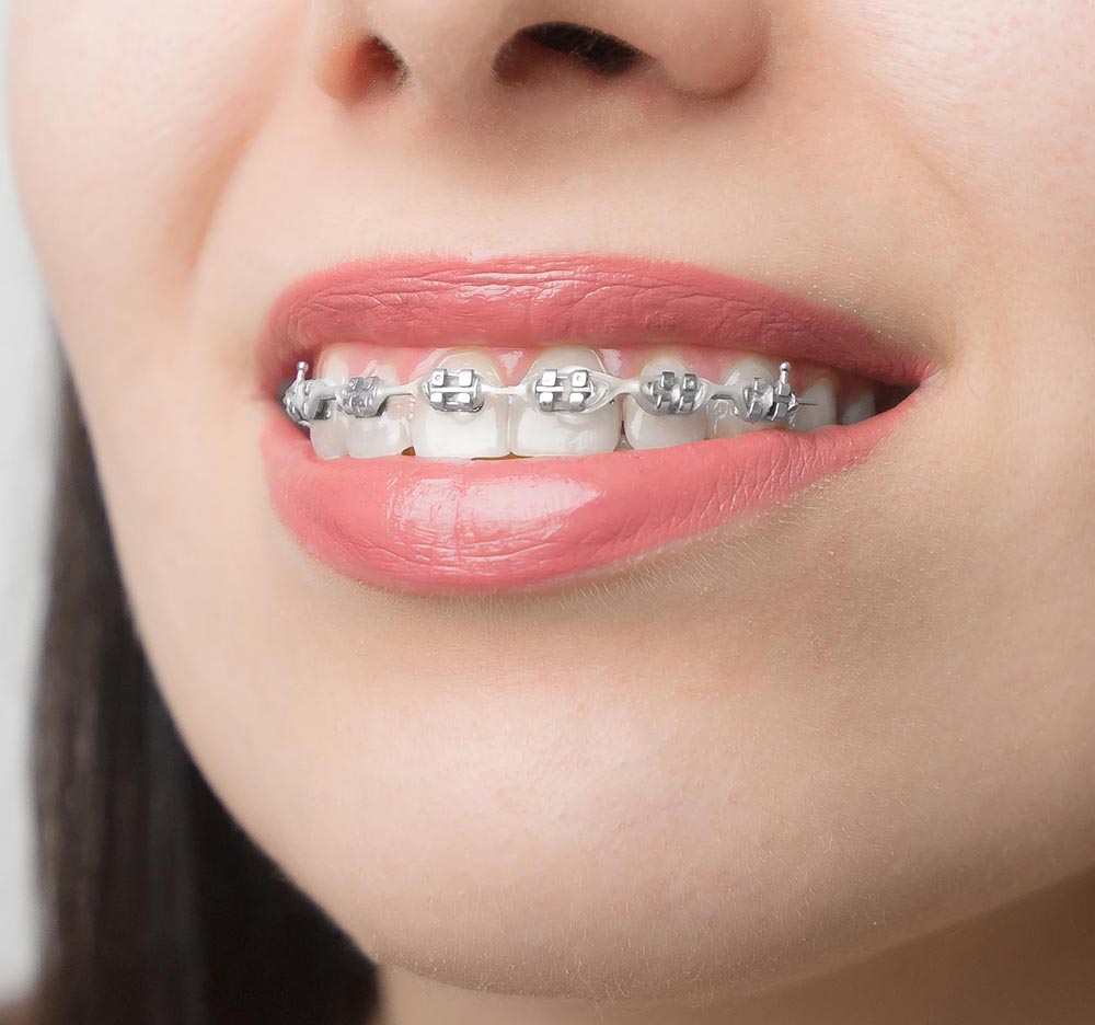 Braces Near Me Whittier CA