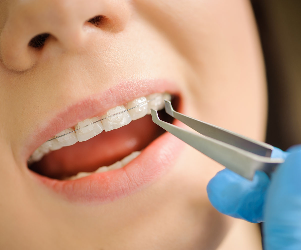 Porcelain Braces Whittier CA