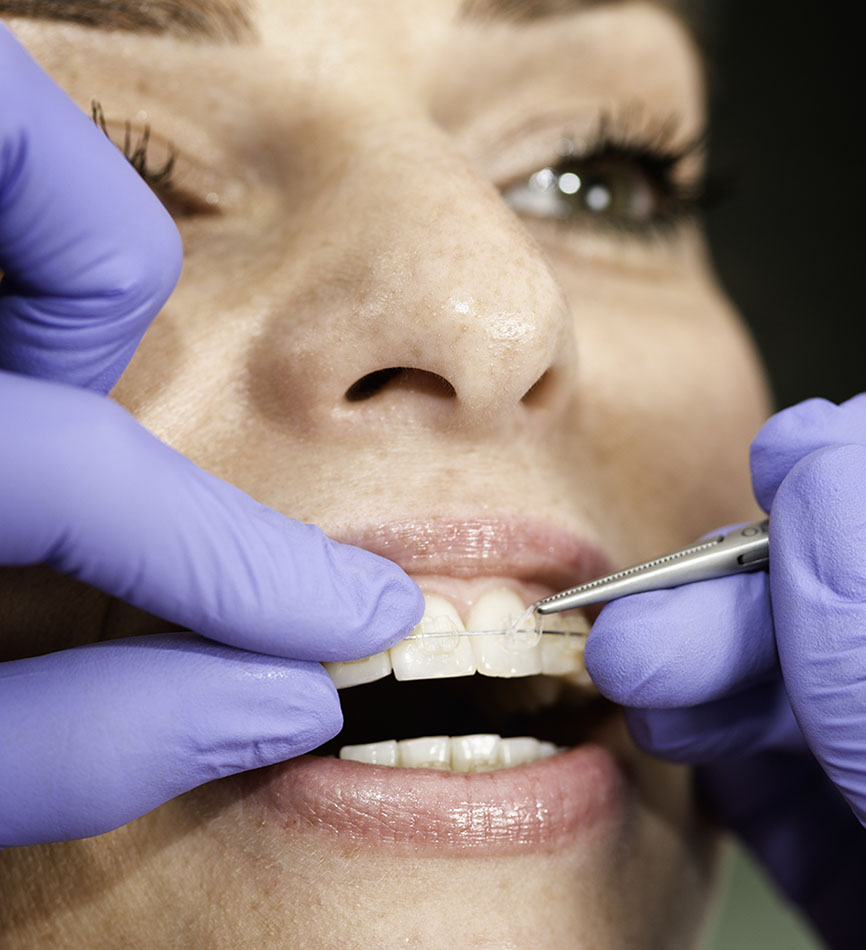 Ceramic Braces Whittier CA