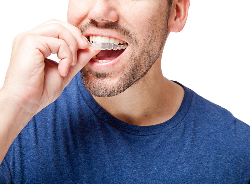 Clear Braces Whittier CA